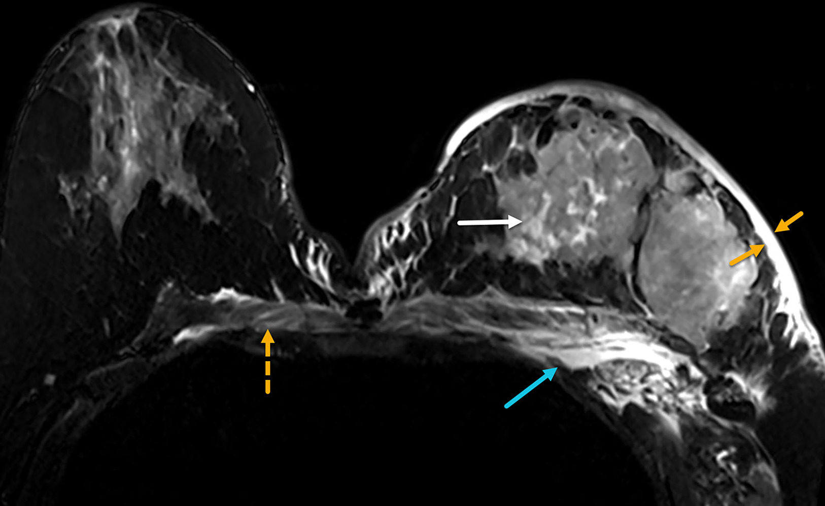Noncontrast axial T2 MRI of both breasts in a patient with inflammatory breast cancer who presented with a 1-month history of rapid left breast swelling and redness that did not improve with antibiotic therapy. MRI demonstrates edema (bright T2 signals) in the thickened skin (yellow arrows), in the tumoral masses (white arrow), and in the chest wall and subpectoral region (blue arrow). Edema also crosses the midline into the contralateral chest wall (dotted yellow arrow). BI-RADS Category 5: highly suggestive of malignancy.