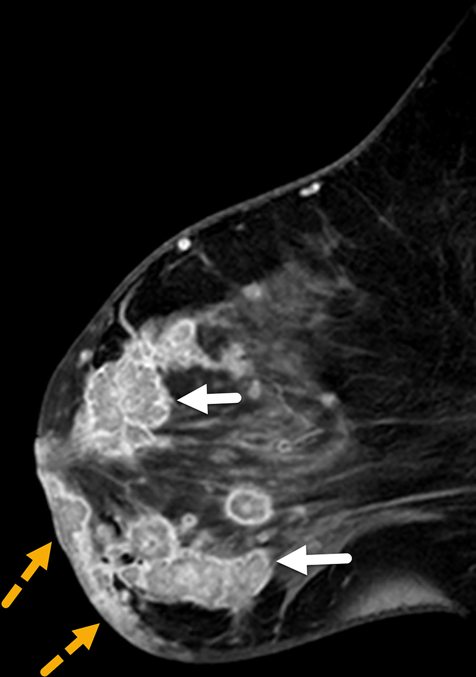 Sagittal postcontrast MRI of the left breast in a patient with inflammatory breast cancer who initially presented with mastitis-like symptoms not resolved with antibiotics. MRI demonstrates global skin thickening with multiple skin lesions in the dermis of the inferior breast (dotted yellow arrows). Conglomerate of suspicious breast masses are seen in all quadrants (solid white arrows). BI-RADS Category 5: highly suggestive of malignancy.