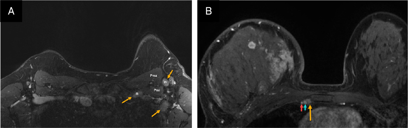 (A) Axial postcontrast MR image in a patient with inflammatory breast cancer (IBC) shows suspicious left axillary level I and III lymph nodes (solid yellow arrows). Biopsy confirmed metastatic adenopathy. Pma, pectoralis major muscle; Pmi, pectoralis minor muscle. (B) Axial postcontrast MRI in another patient with IBC shows suspicious right internal mammary node (yellow arrow) next to the internal thoracic vein (blue arrow). Biopsy of the internal mammary Internal thoracic artery (red arrow).