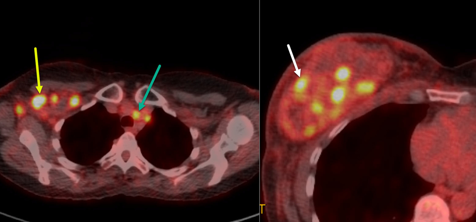 Two axial images of the 18-FFDG-PET/CT exam in a patient with inflammatory breast cancer reveal right axillary level I, II, and III hypermetabolic nodes (yellow arrow) and contralateral superior mediastinal nodes (green arrow). The patient has multiple hypermetabolic right breast tumoral masses (white arrow) within the enlarged inflamed right breast.