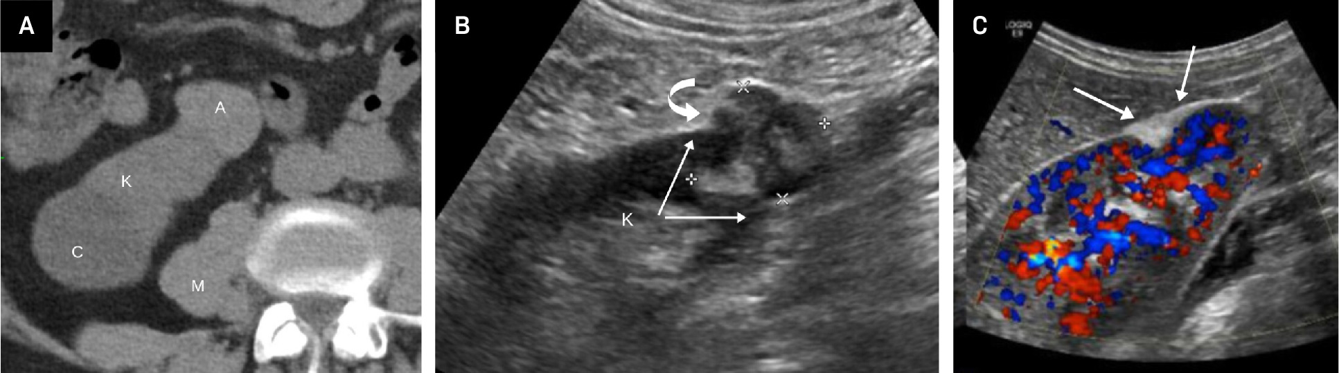 Fat-poor angiomyolipoma (fpAML) with angular interface. CT scan (A) showing the right kidney [K] with a simple cyst [C] and a fpAML [A]. The Hounsfield unit of the fpAML was 50 and identical to the HU of the adjacent muscle [M]. US showed this fpAML (B) to have mixed echogenicity, with an angular interface (arrows) and some overflow of the renal cortex (curved arrow, K = kidney). US of peripheral AMLs (C), which, like fpAMLs, often have the “overflowing beer” sign (arrows) with the renal cortex. The presence of either an angular interface or “overflowing beer” sign is helpful in distinguishing fpAMLs from renal cell carcinomas.