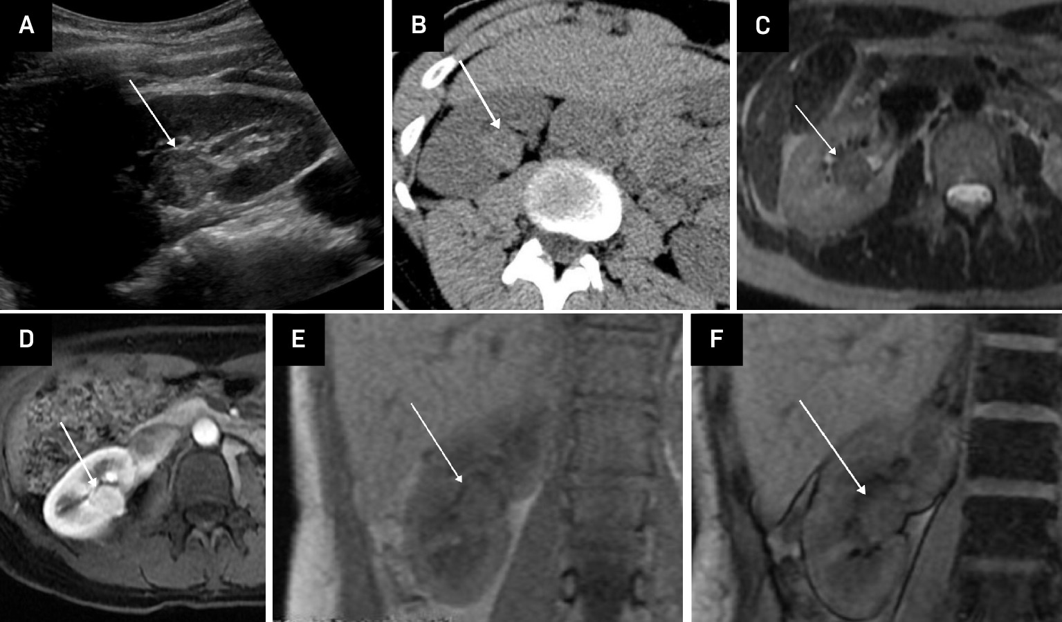 Hyperattenuating fat-poor angiomyolipoma (fpAML) in an adult female. US of the right kidney showing an echogenic mass (arrow) (A). Non-contrast CT shows the mass to be hyperattenuating, with Hounsfield units >45 (arrow) (B). Axial single-shot fast spin echo (SSFSE) T2-weighted MRI shows the mass to be of low signal intensity (arrow) (C). Contrast-enhanced LAVA FLEX (FAT SAT) MRI shows early contrast enhancement of the mass (arrow) (D). Chemical shift imaging with in-phase LAVA FLEX coronal MRI showing the mass (arrow) (E). Chemical shift imaging with out-of-phase LAVA FLEX coronal MRI shows no signal drop-out within the mass (arrow) indicative of no microscopic fat (F).