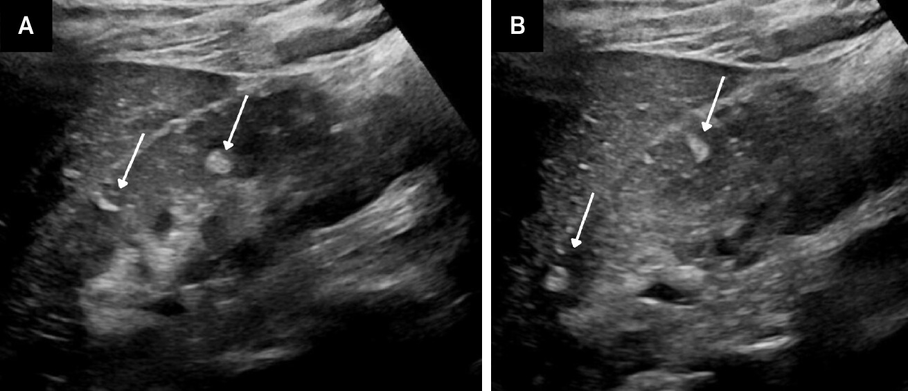 Angiomyolipomas (AMLs) on US. Adolescent with tuberous sclerosis and multiple echogenic AMLs (arrows) within the right kidney (A). Similar masses were seen in the left kidney (B).