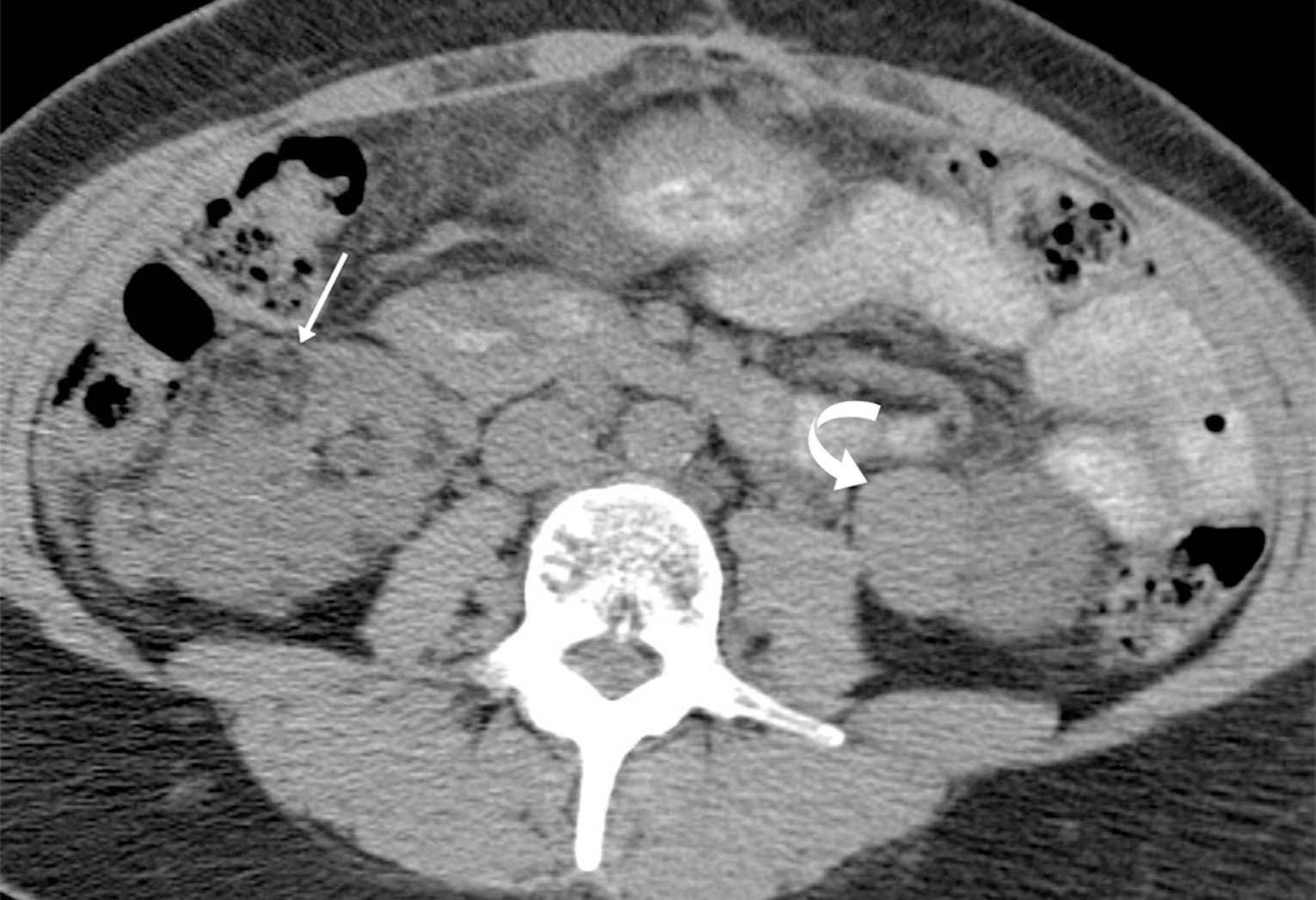 Angiomyolipomas (AMLs) on CT. Adult with tuberous sclerosis and multiple AMLs, most of which are classic with macroscopic fat (arrow) in the right kidney, but hyperattenuating fat-poor AML (curved arrow) in the left kidney.