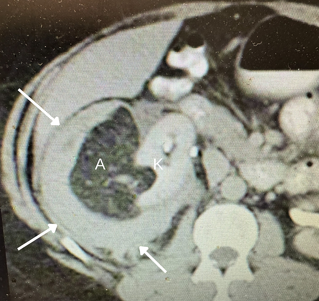 Hemorrhage in large angiomyolipoma (AML). Adult with sudden onset of right flank pain. Coronal reformation contrast-enhanced CT showing left upper pole AML with angular interface (arrow). There is a large hematoma (H) that extends into the pelvis (B = bladder).