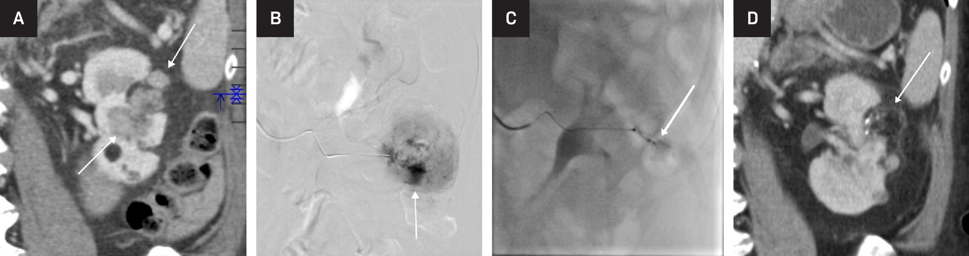 Embolization of large angiomyolipoma (AML). Coronal reformation contrast-enhanced CT showing AML with a large solid component (arrows) (A). Selective catheter angiography showing pooling of contrast (arrow) within the AML (B). Post-embolization catheter angiography showing near-complete occlusion of the vascular component of the AML (arrow) (C). Follow-up coronal reformation contrast-enhanced CT showing regression of the solid component of the AML, with some of the fatty component still visible (arrow) (D).
