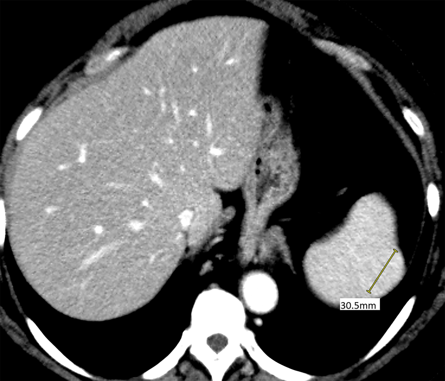 Axial CT abdomen demonstrates a mildly hyperdense solitary 3.1 cm lesion in portal venous phase.