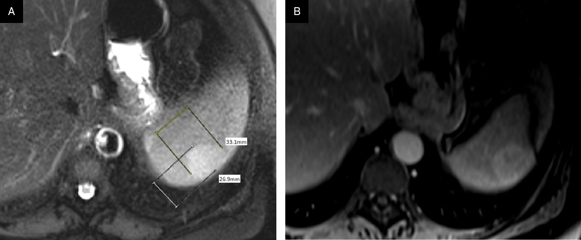 (A) T2 axial MRI demonstrates a mildly hyperintense 3.3 cm × 2.7 cm solitary lesion in the periphery of the spleen. (B) Post-contrast MRI scan in the portal venous phase demonstrates mildly heterogeneous enhancement.