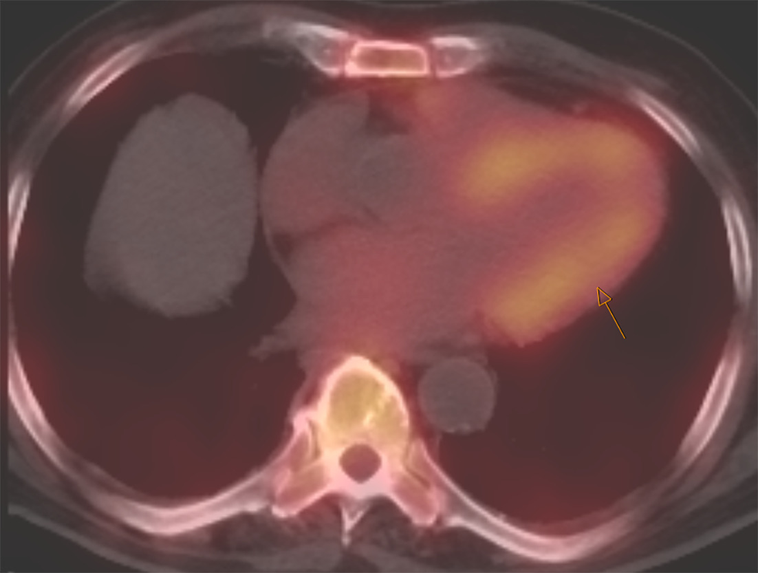 SPECT/CT image of the chest with strong myocardial uptake (shown by arrow) consistent with TTR amyloidosis.