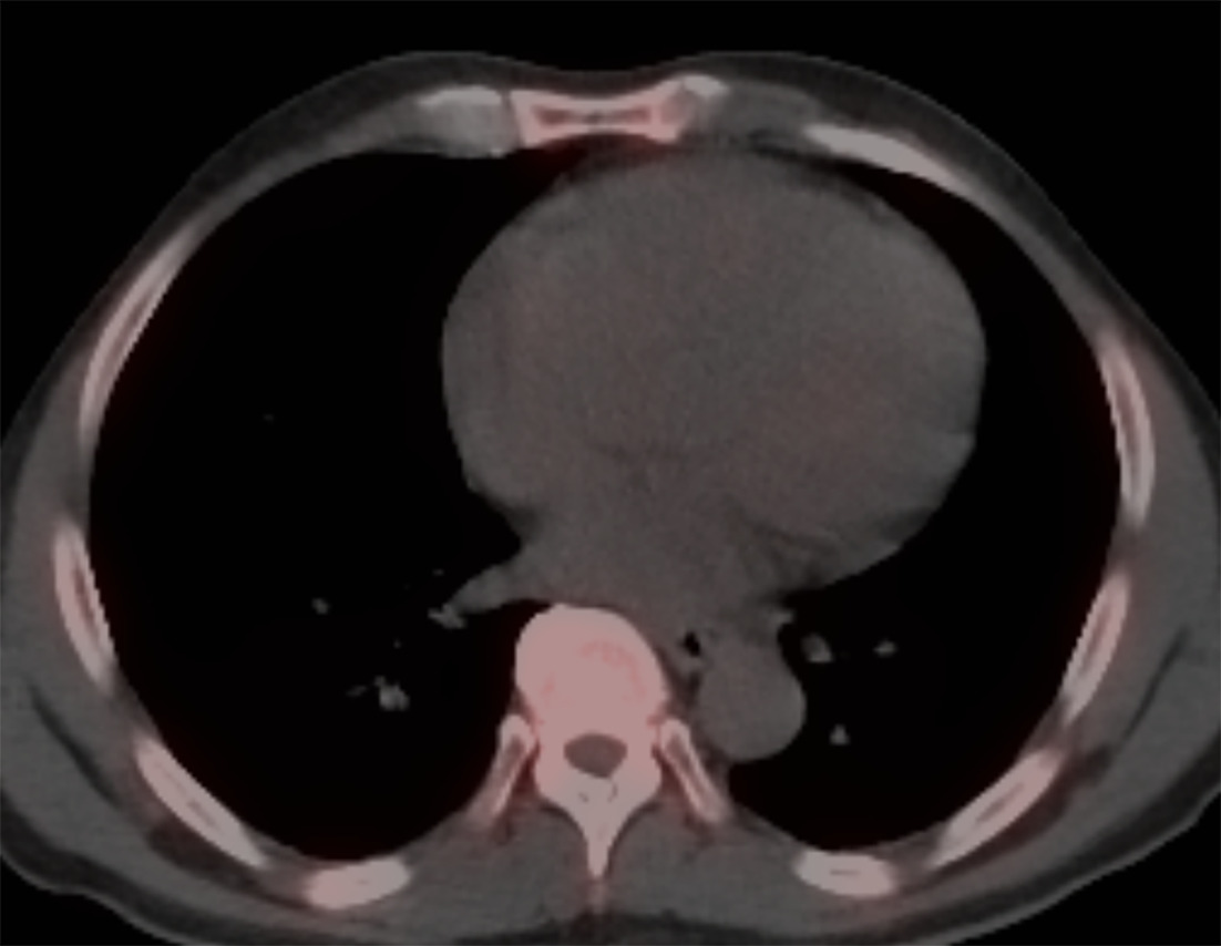 SPECT/CT image of the chest without any myocardial uptake, ruling out the possibility of TTR amyloidosis.