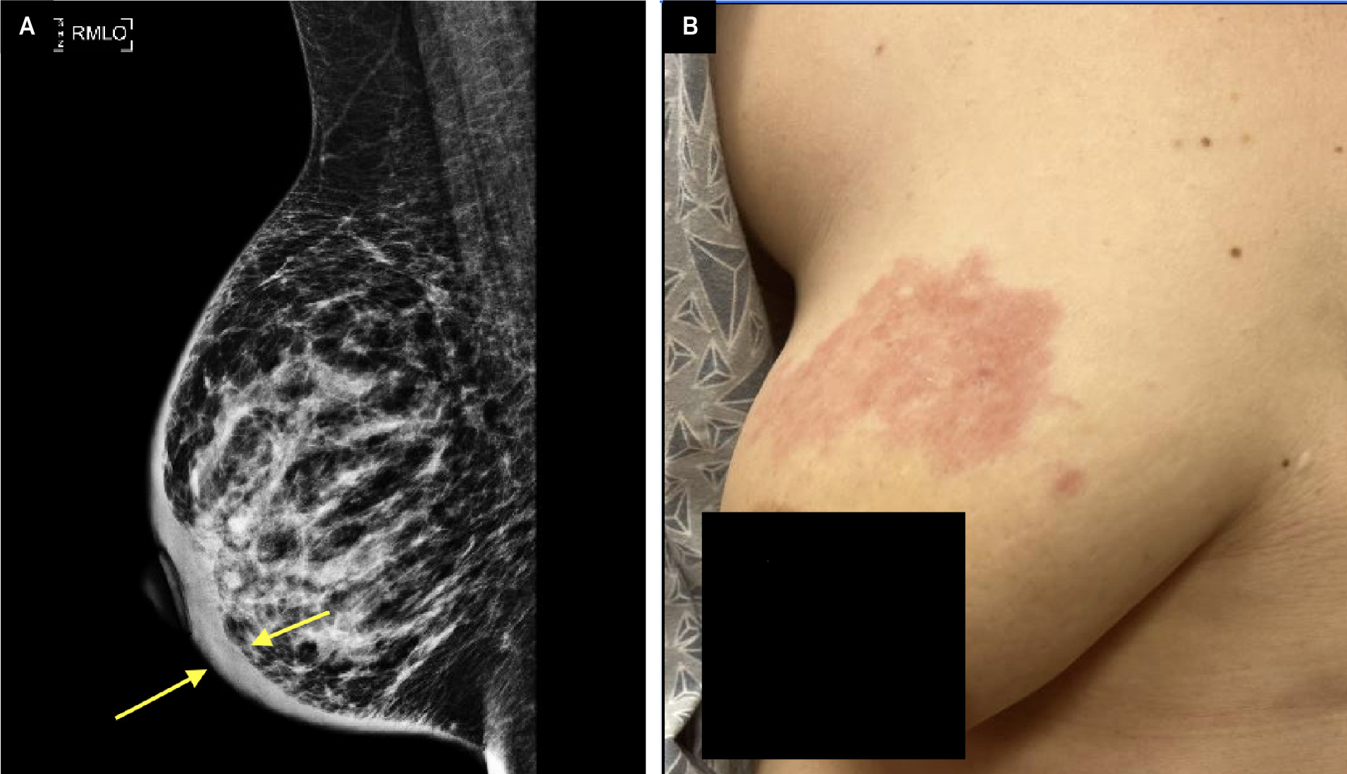 Mediolateral oblique view mammogram. Diffuse thickening of the dermis (yellow arrows) with trabecular coarsening and thickening in the right breast is seen (A). No masses are visible. Clinical photograph (B) shows a worsening right breast lesion after 1 month of topical triamcinolone.