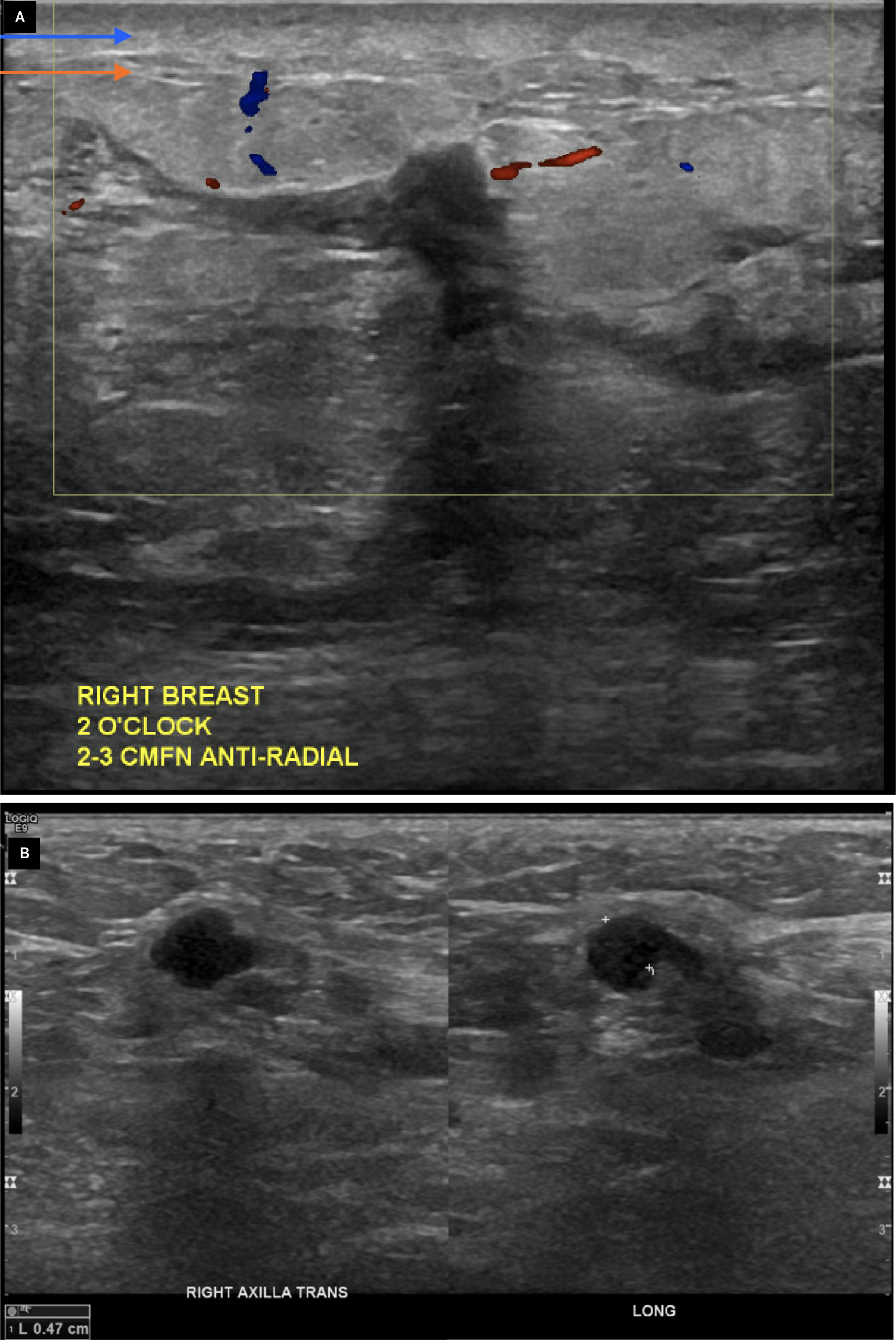 Ultrasound of the right breast imaging shows dermal thickening (blue arrow) with underlying edema (orange arrow), as well as ill-defined hypoechoic collections without discernible Doppler flow (yellow box) at the 2 o’clock position (A). Ultrasound of the right axilla (B) shows a lymph node with an eccentrically thickened cortex (white markers) measuring 0.47 cm and a diminutive fatty hilum.