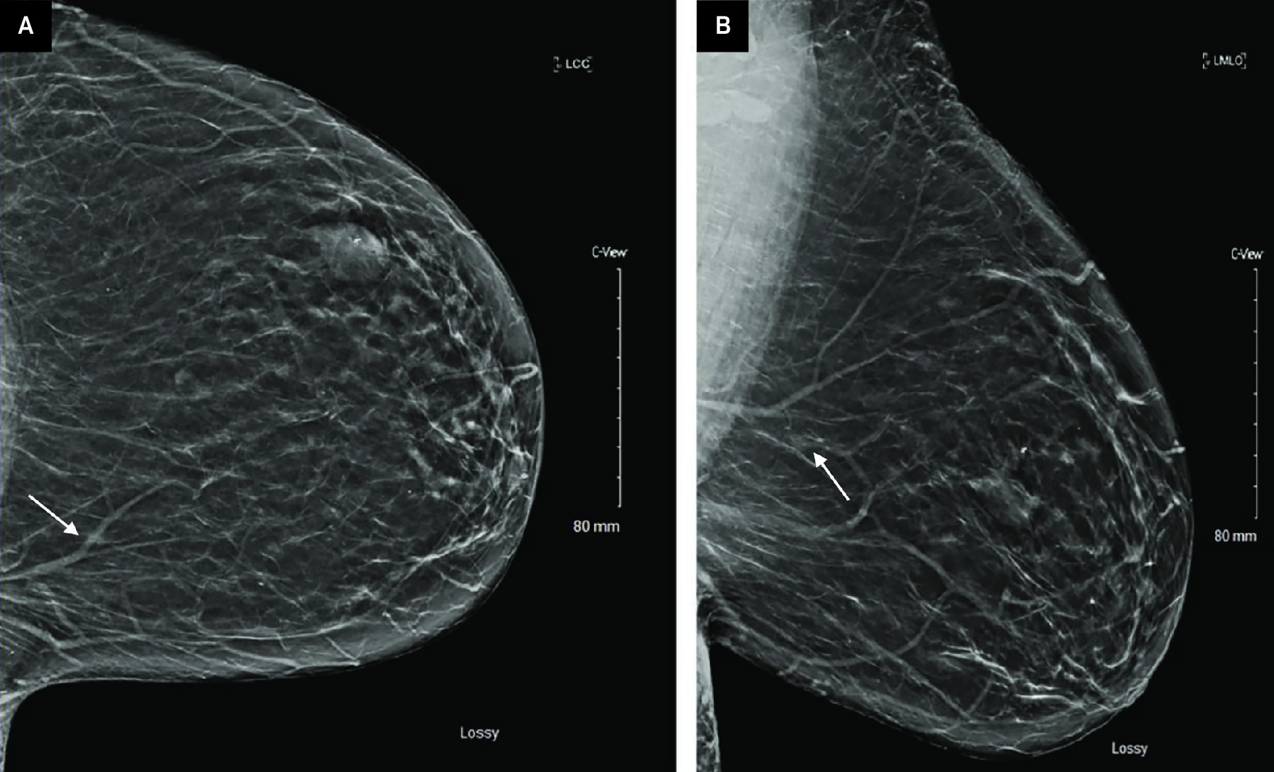 Screening full-field digital mammography with DBT of the left breast in the CC (A) and MLO (B) projections demonstrates a focal asymmetry in the left breast upper inner quadrant, posterior depth (arrows). An additional stable fibroadenoma in the upper outer left breast, middle depth (arrowhead)