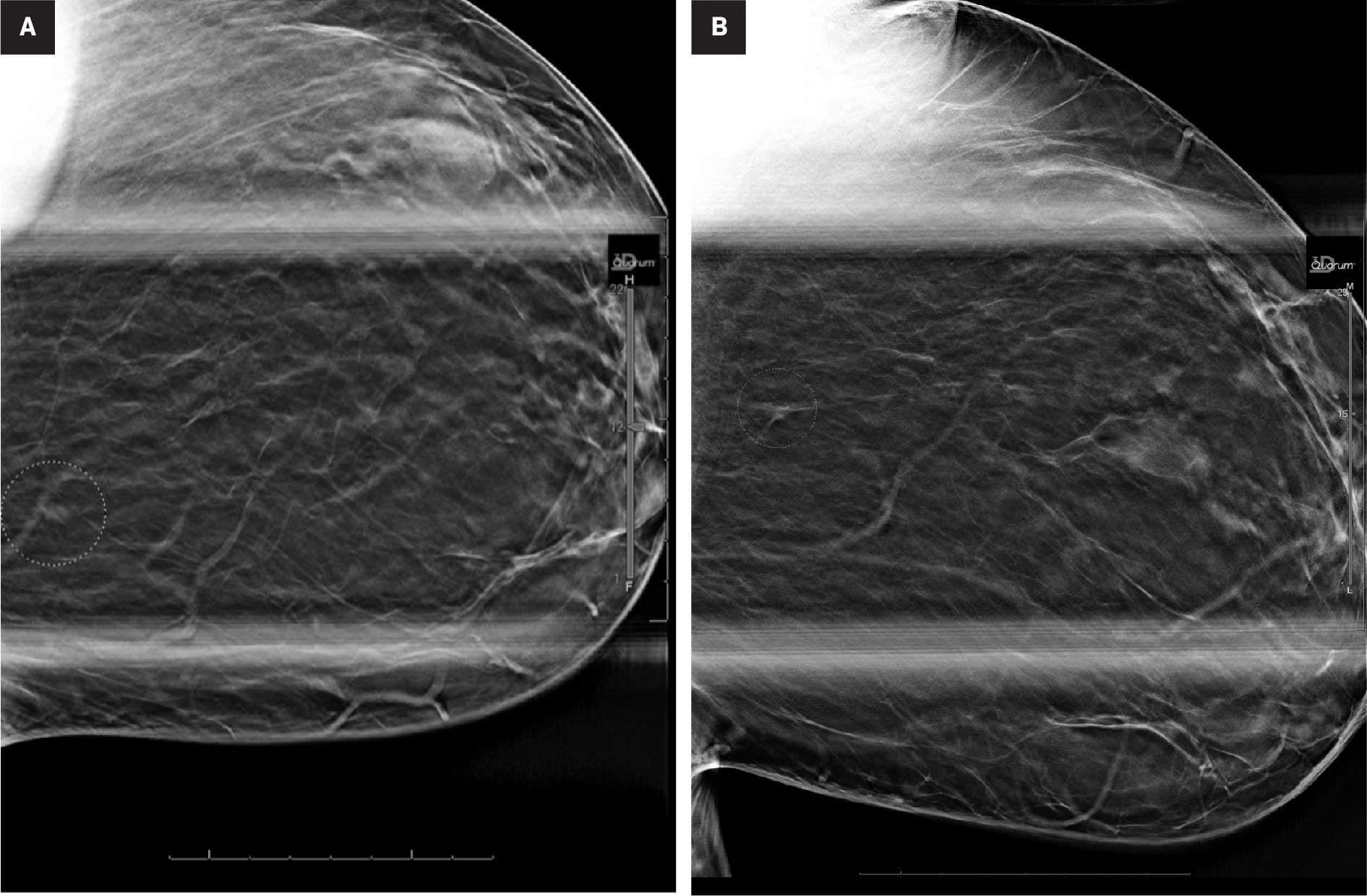Diagnostic spot compression views with DBT in the CC (A) and MLO (B) projections confirm a focal asymmetry in the upper inner left breast, posterior depth (circles)