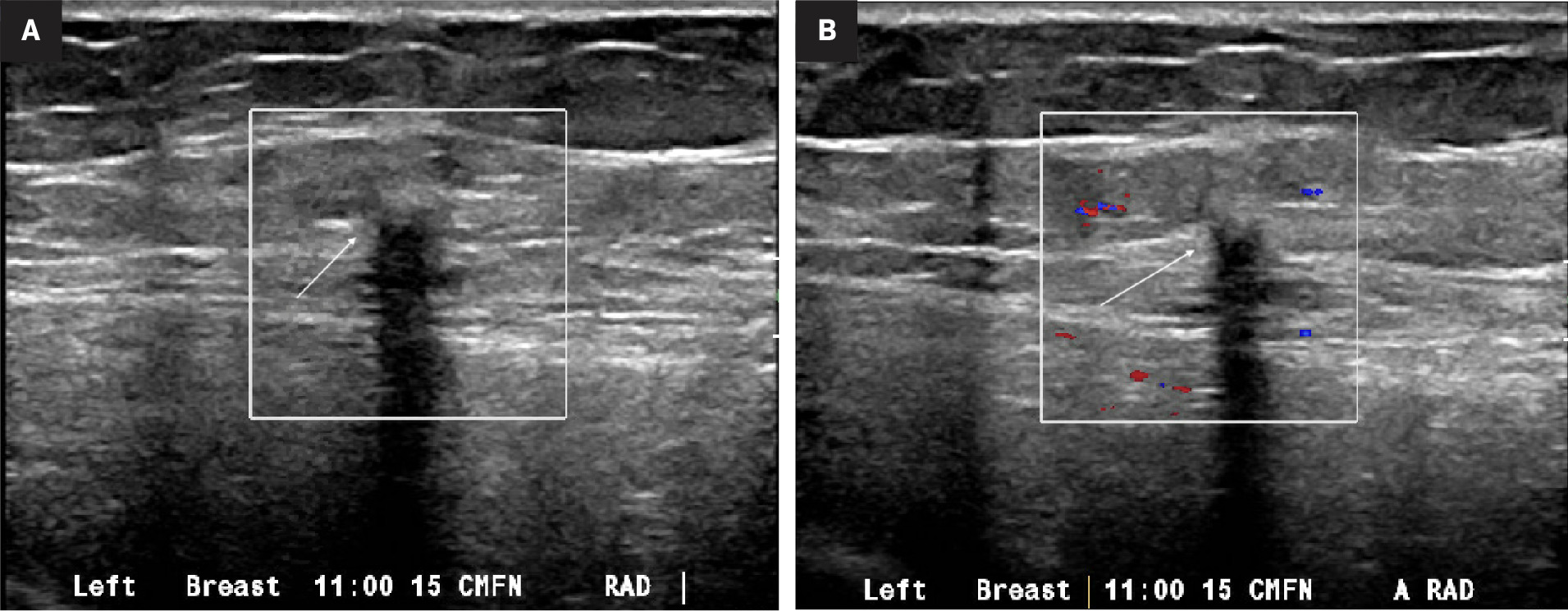 Targeted gray scale (A) and color Doppler (B) ultrasound demonstrates an irregular hypoechoic mass with posterior acoustic shadowing at 11 o'clock, 15 cm from the nipple (arrows)