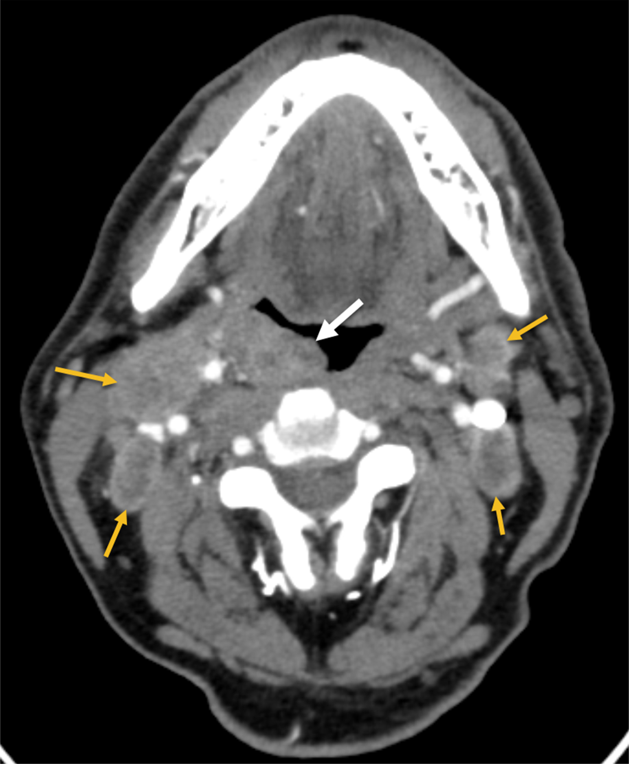 CT scan of the neck with intravenous contrast demonstrates a right palatine tonsil mass (white arrow) and bilateral neck lymphadenopathy (yellow arrows).