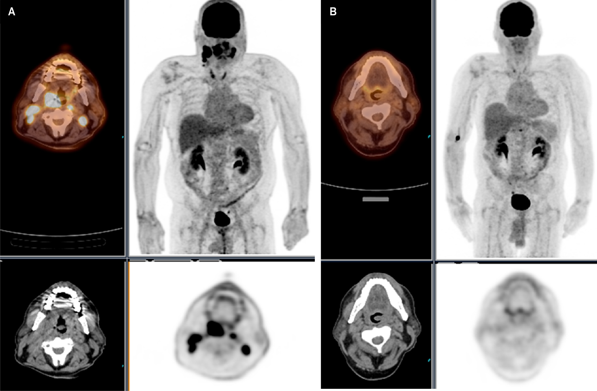 (A) An F-18 fluorodeoxyglucose (18FFDG) PET/CT scan with significant uptake in the right palatine tonsil and bilateral neck lymph nodes. (B) 18FFDG PET/CT scan demonstrates complete metabolic response and resolution of abnormal metabolism in the right palatine tonsil and bilateral neck lymph nodes.