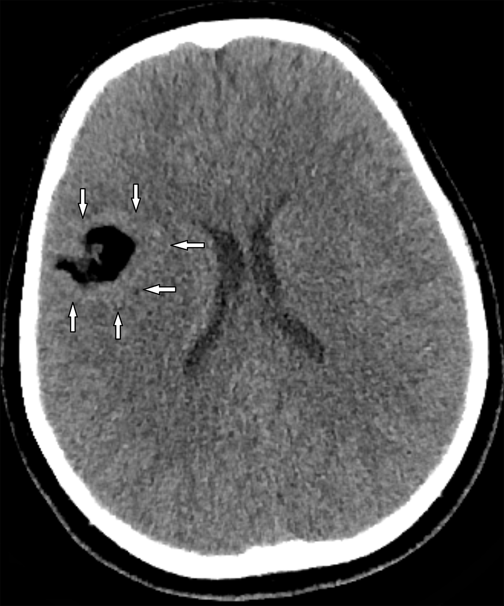 Axial CT image demonstrates a well-defined extra-axial mass of fat attenuation with lobulated margins centered in the right Sylvian fissure. The surrounding cortex appears abnormally thickened (arrows).