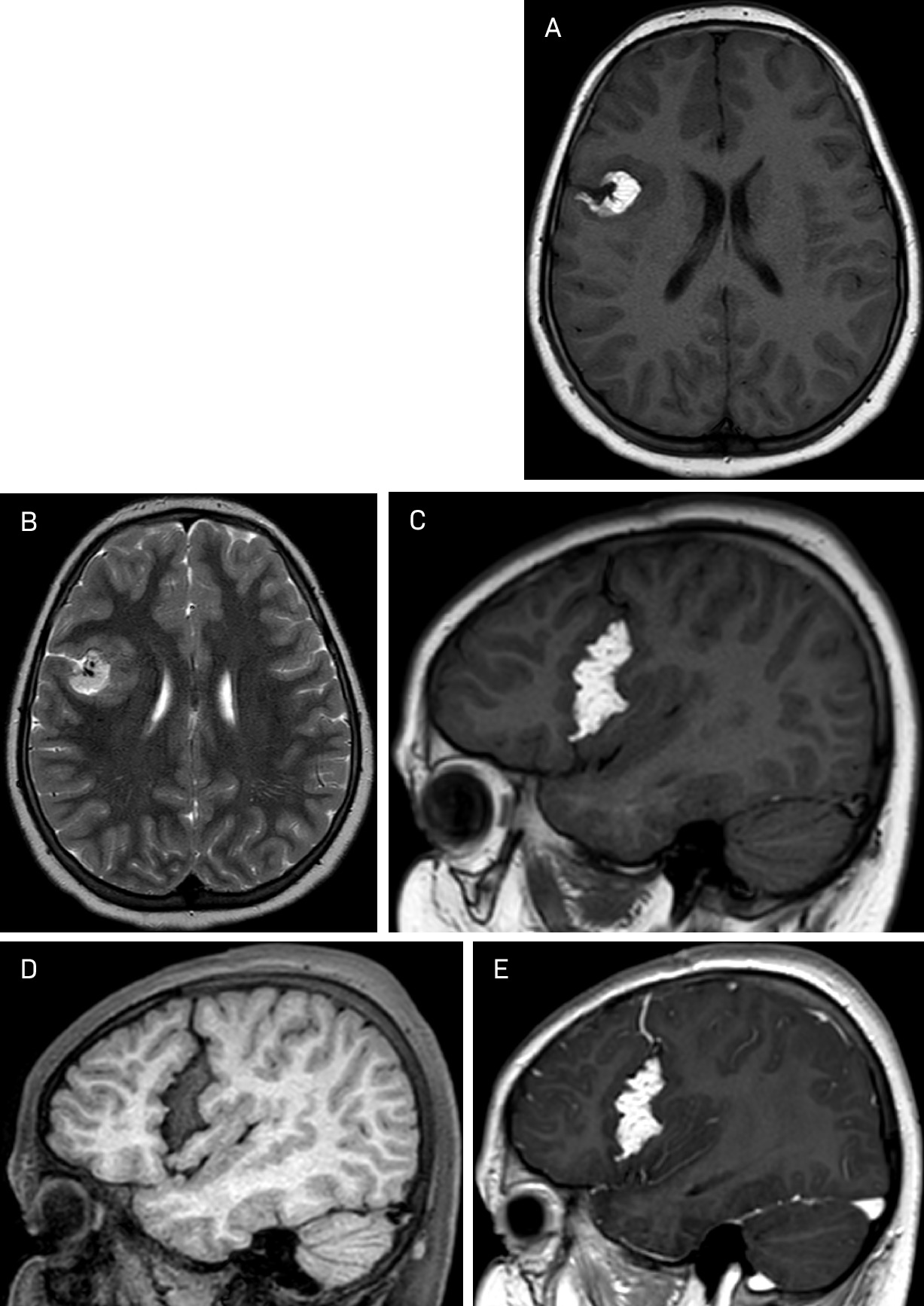 (A, B, C) Axial T1, T2, and sagittal T1 show a well-defined high signal intensity extra-axial mass in the right Sylvian fissure. The cortical gray matter-lined cleft encasing the mass does not abut the ependymal surface of the lateral ventricle. Fat saturation sagittal T1 (D) shows signal dropout. Sagittal T1 post-gadolinium (E) shows no enhancement except for the venous component traversing through the lesion.
