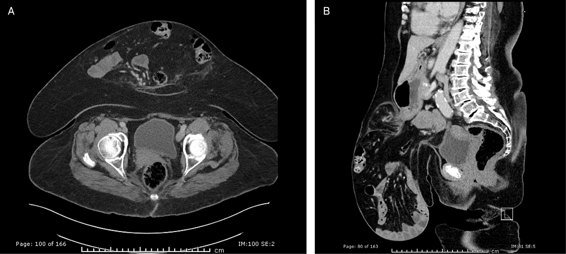 Abdomen and pelvis CT with intravenous contrast at initial presentation. (A) Axial slice at the level of the hips demonstrating a large midline ventral abdominal wall hernia sac containing large and small bowel with associated mesentery. (B) Parasagittal slice demonstrating a large complex paraumbilical hernia with dominant wide-necked hernia sac containing large and small bowel without evidence of bowel obstruction or strangulation. No herniation of the stomach in the hernia sac.