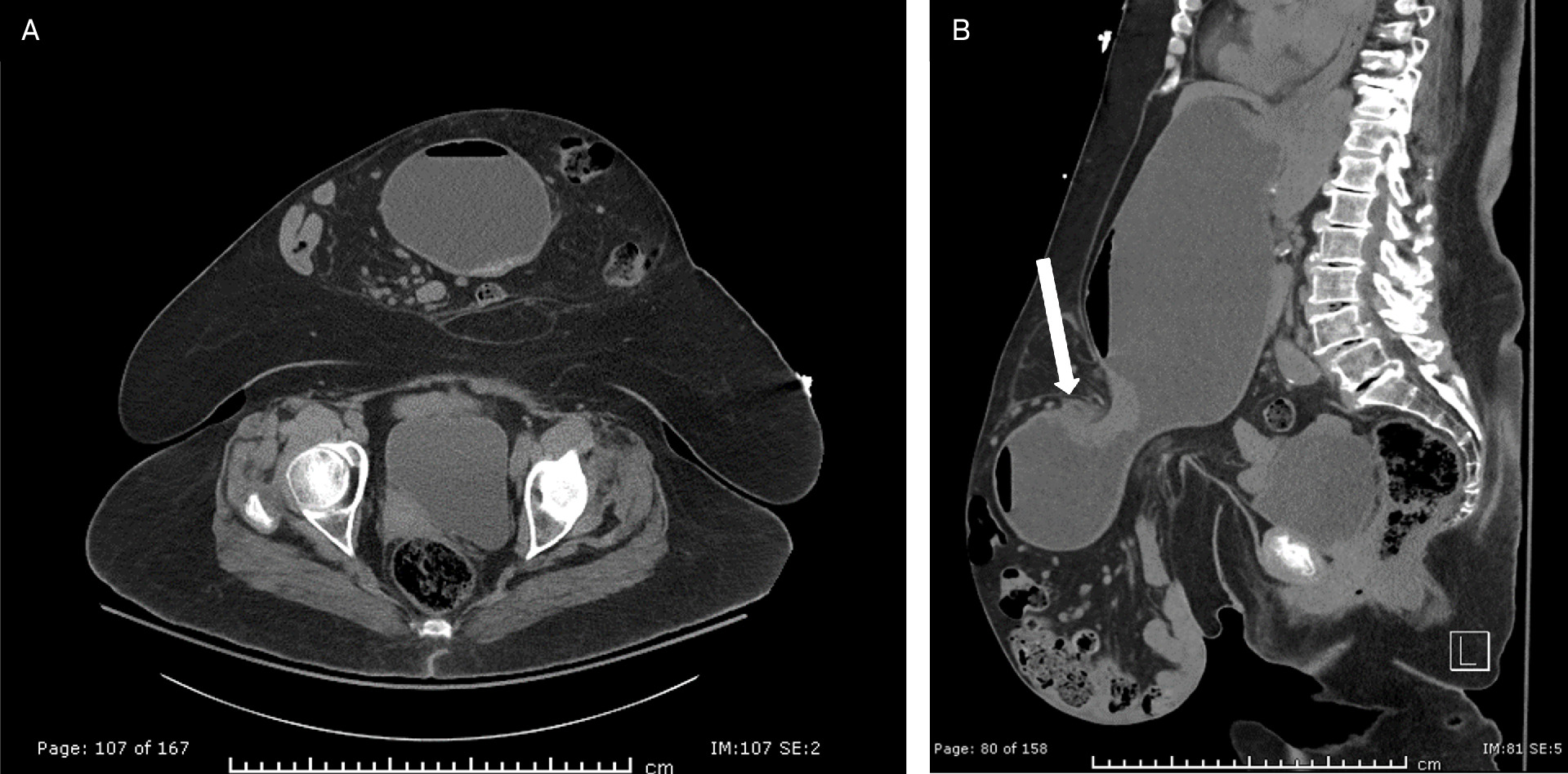 Abdomen and pelvis CT with intravenous contrast obtained 1 month later. (A) Axial slice showing interval herniation of the distal stomach into the sac along with previously seen colon and small bowel. (B) Parasagittal slice demonstrating a significantly distended stomach which narrows as it passes through the hernia neck. The proximal duodenum is also seen in the hernia sac (white arrow). There was no evidence of bowel strangulation. However, the patient had a resultant gastric outlet obstruction at this time, as evidenced by her fluid-distended stomach.