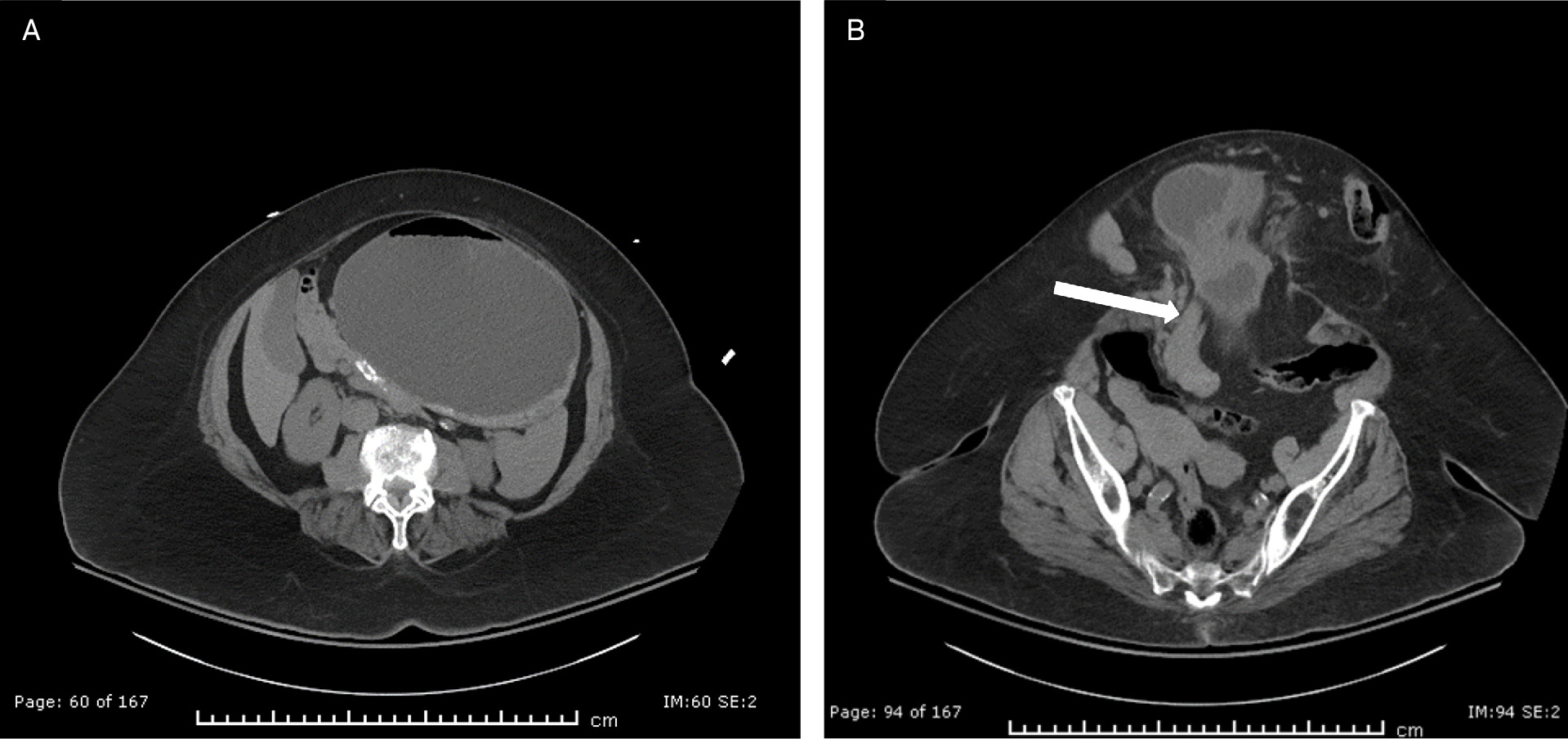 Additional contrast-enhanced abdomen and pelvis CT images acquired during the 1-month follow-up. (A) A more superior axial slice at the level of the kidneys demonstrating a fluid-distended stomach as a result of gastric outlet obstruction. (B) Axial slice at the level of the hernia neck showing herniation of the proximal duodenum (white arrow) and distal stomach with narrowing through the hernia neck.