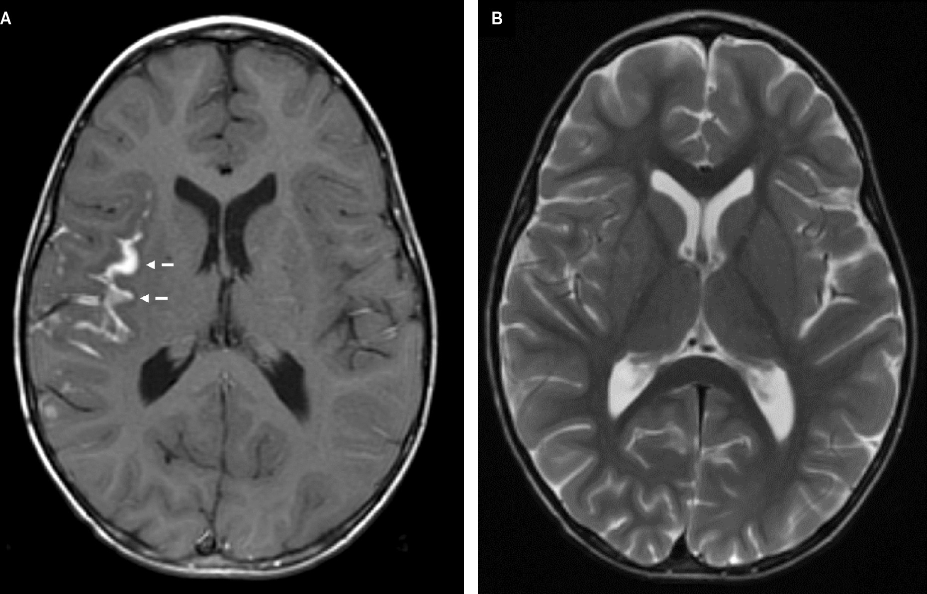 A post-contrast axial gradient-echo T1-weighted image (A) demonstrates gyriform enhancement in the deep Sylvian fissure, most pronounced along the insular cortex (dashed arrows). The corresponding axial turbo spin echo T2-weighted image (B) demonstrates no significant surrounding parenchymal vasogenic edema. The lesion is not easily visible on this sequence.