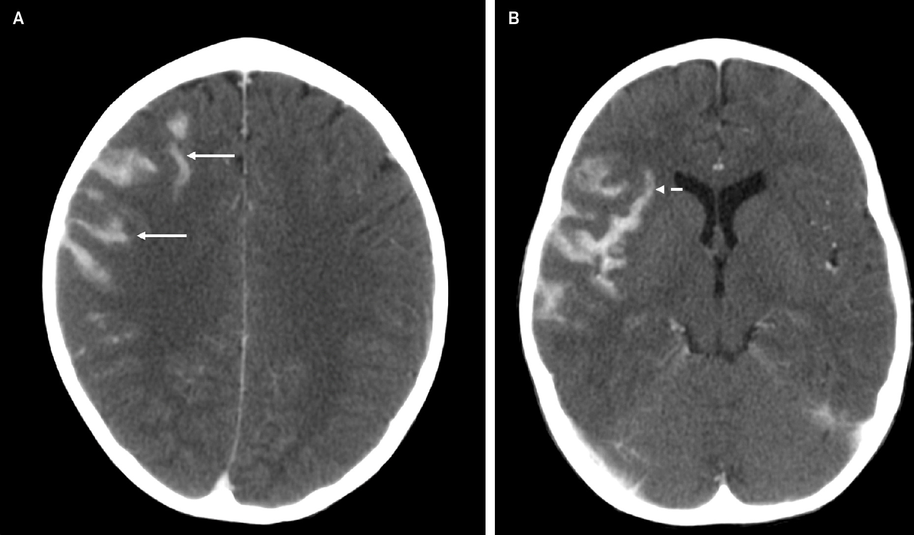Post-contrast axial brain CT images demonstrate new, mass-like hyperattenuation in the right frontal lobe (A, solid arrows) and more pronounced hyperattenuating lesions in the right Sylvian fissure, in a gyriform distribution along the insular cortex and frontotemporal operculum (B, arrows), compared with a brain MRI 19 days earlier.