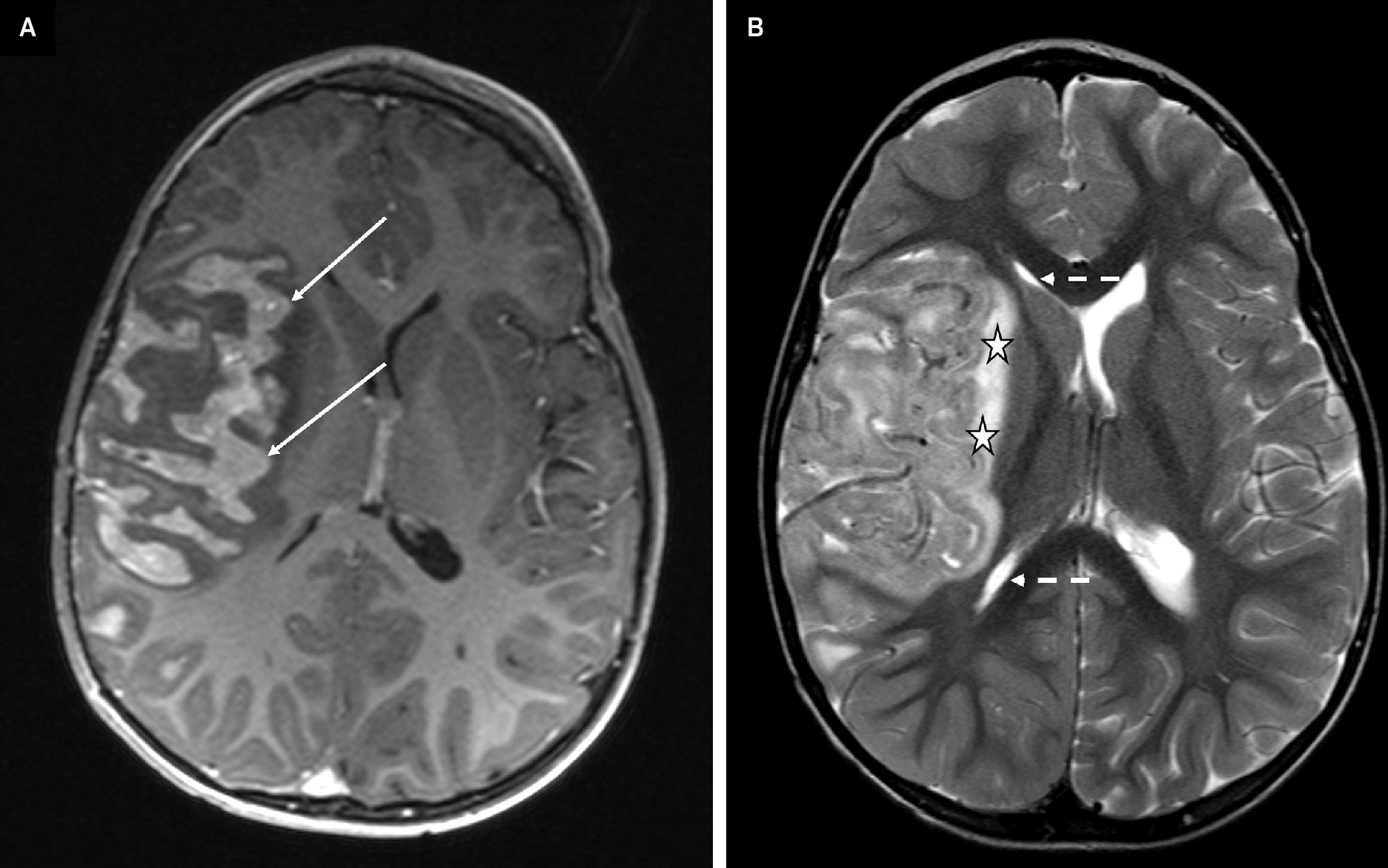 Axial post-contrast gradient echo T1-weighted image (A) and axial turbo spin-echo T2-weighted image (B). A brain MRI performed one week after CT demonstrates rapid progressive disease with an enhancing mass-like lesion with a gyriform distribution occupying the sulci, consistent with leptomeningeal disease (A, solid arrows). Note the interval worsening of the right cerebral hemisphere edema seen with T2 signal of the underlying brain parenchyma (B, stars), partial effacement of the right lateral ventricle (B, dashed arrows), and leftward midline shift.
