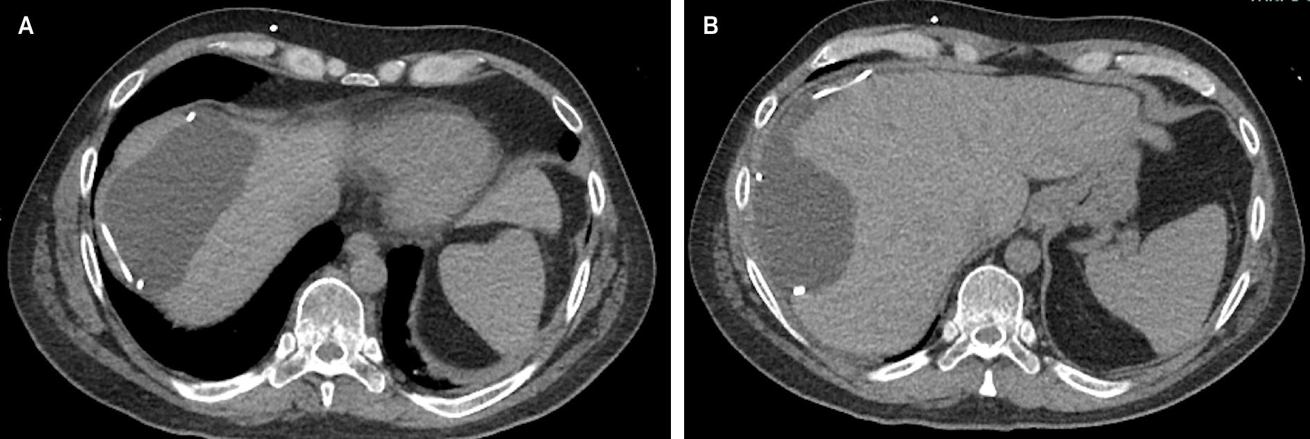(A, B) Axial CT without contrast shows a large mass in the right upper quadrant measuring 10.9 × 11.5 × 5.6 cm, appearing as a loculated collection that deforms the contour of the liver containing the distal tip of a VP shunt catheter.