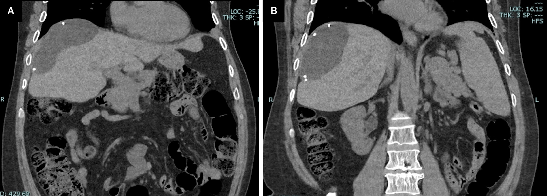 (A, B) Coronal CT without contrast shows a well-demarcated abdominal mass at the superior lateral portion of the liver, deforming its contour.