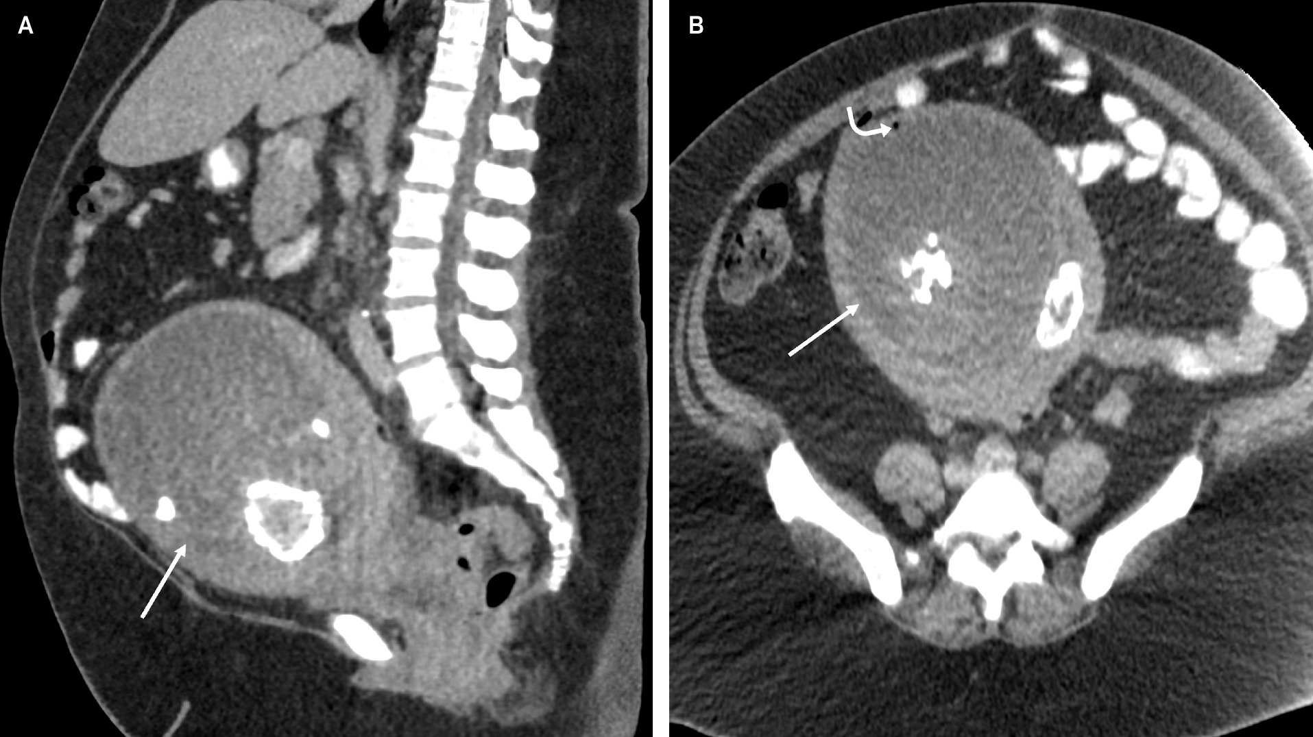Sagittal (A) and axial (B) CT of the abdomen and pelvis after the administration of intravenous contrast shows an enlarged uterus with a centrally necrotic and partially calcified myometrial mass (straight arrow). There is a single locule of air within the necrotic portion of the fibroid anteriorly (curved arrow).