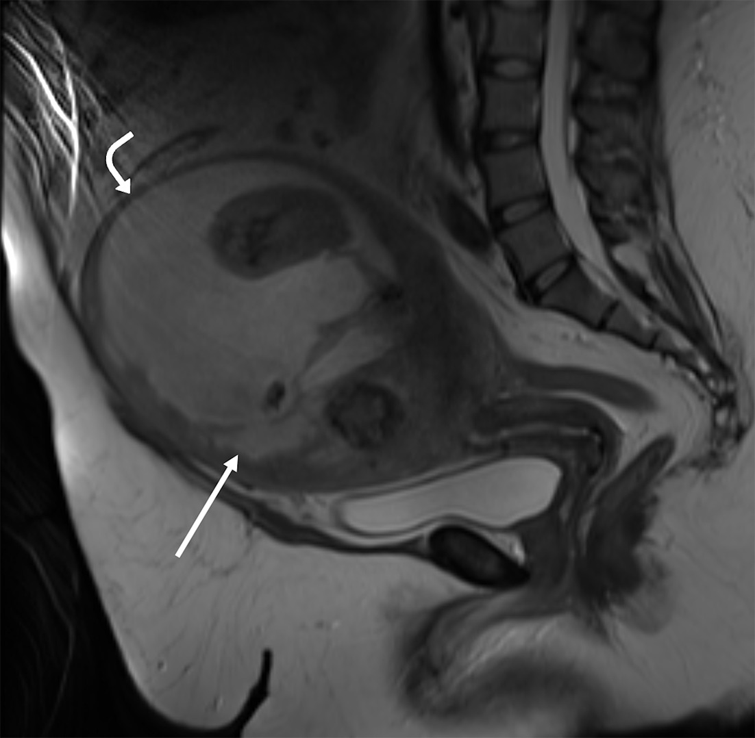 Sagittal T2-weighted MRI of the pelvis without intravenous contrast shows an enlarged uterus with a large, heterogeneous necrotic myometrial mass with cystic, solid, and calcified components (straight arrow). The small locule of gas visualized on the CT was not visualized at the time of MRI. There is marked myometrial thinning along the anterior and superior margins of the necrotic mass (curved arrow).