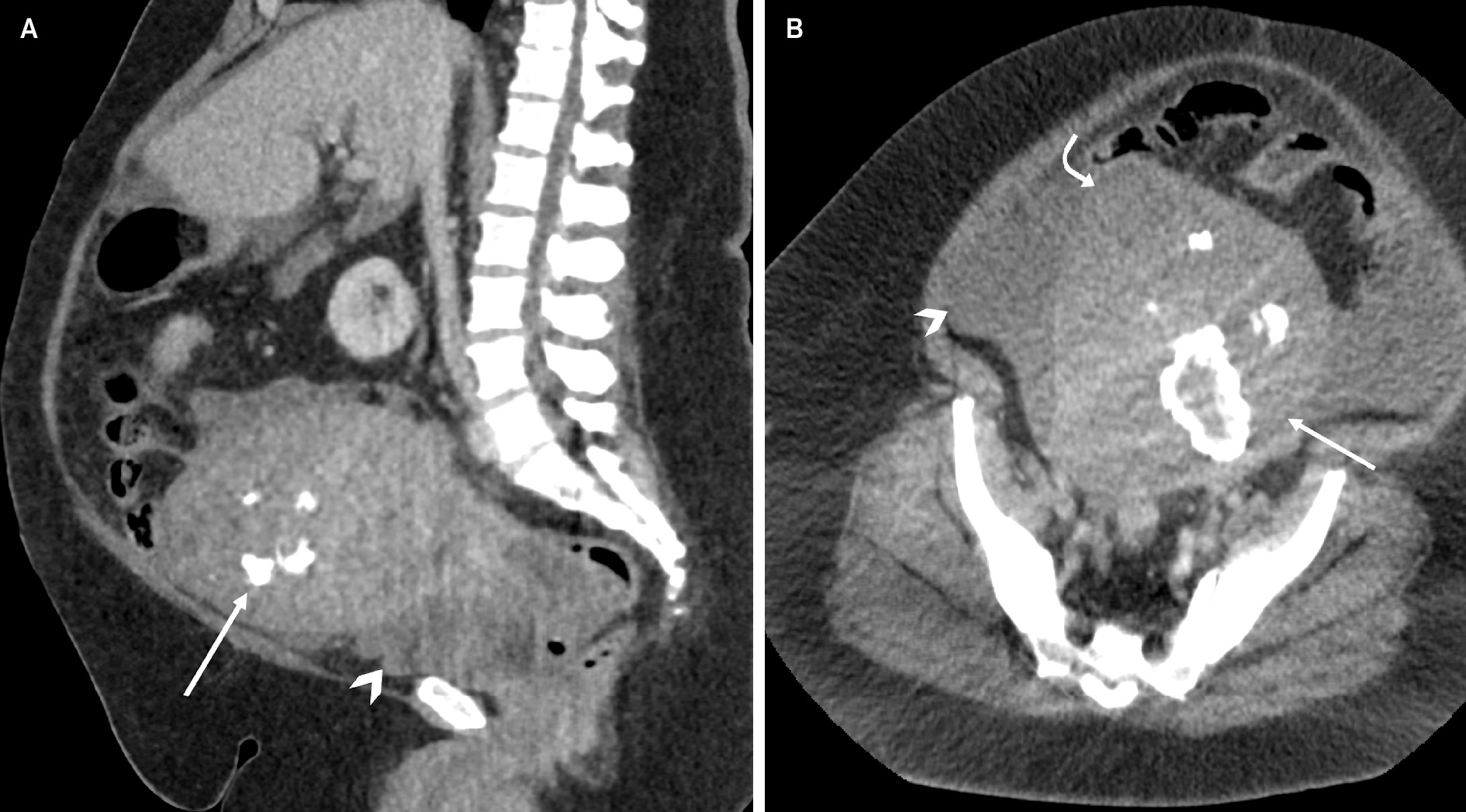 Sagittal (A) and axial (B) CT of the abdomen and pelvis after the administration of intravenous contrast, obtained one month after initial presentation, shows a significant decrease in size of the cystic component of the previously visualized large necrotic myometrial mass (straight arrow) with a small to moderate volume complex free fluid (arrowhead). Note the abnormal contour (curved arrow) along the right uterine fundus, suspicious for perforation.