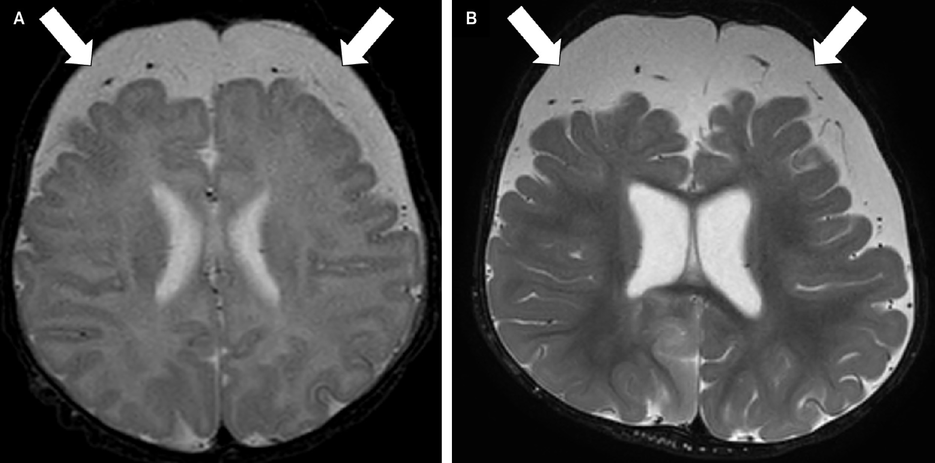 Axial T2-weighted MRI of the brain obtained at 22 days of age (A) and 10 months (B) demonstrates low parenchymal volume, most pronounced in the frontal lobes, with expanded frontal extra-axial cerebrospinal fluid (arrows). Synthetic MRI at 10 months of age revealed brain parenchymal fraction of 10.3 standard deviations below normal for age, CSF volume 6.7 standard deviations above normal for age, and intracranial volume 3.9 standard deviations below normal for age.