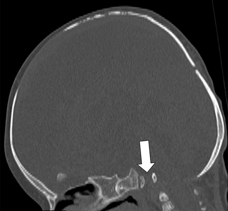 Sagittal CT of the head acquired at 10 months of age uncovered the lack of a clivus (arrow).