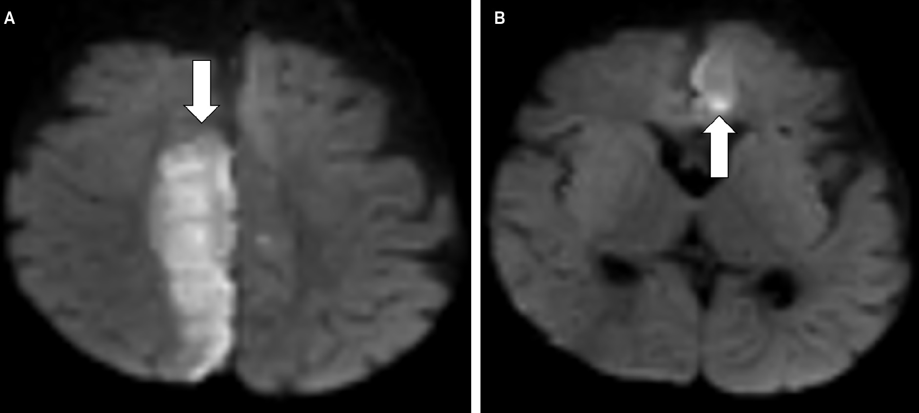 Axial diffusion-weighted MRI of the brain exhibits acute ischemia (arrows) in the posterior right paramedian frontal and parietal lobes (A) and the anterior left frontal lobe (B).