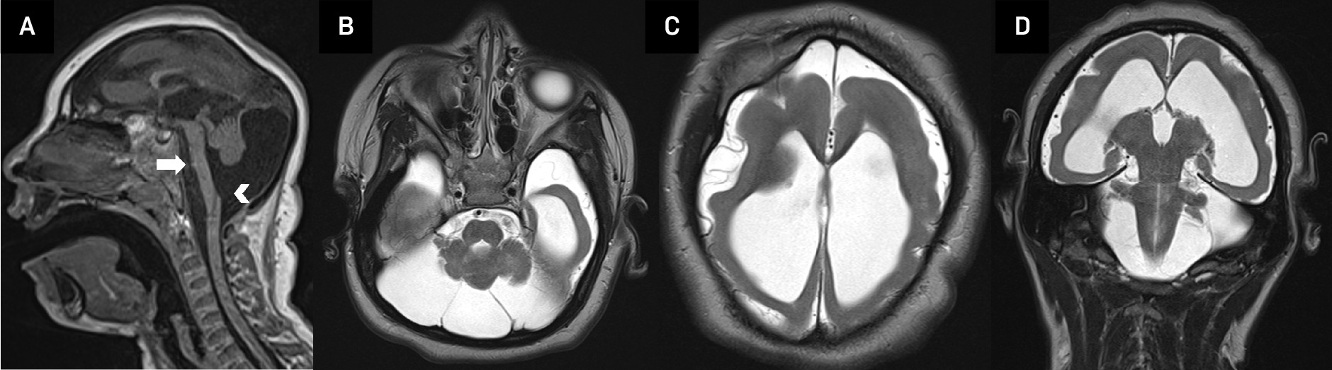 Sagittal T1 brain MRI (A) in a child with congenital ZKV infection shows severe microcephaly, hypoplastic pons (arrow) with a flat ventral surface, and an enlarged mega cisterna magna, which appears to communicate with the fourth ventricle (arrowhead). Axial (B, C) and coronal (D) T2 brain MRI demonstrate a hypoplastic cerebellum, as well as a markedly diffuse simplified gyral pattern with abnormal myelination and ventriculomegaly.