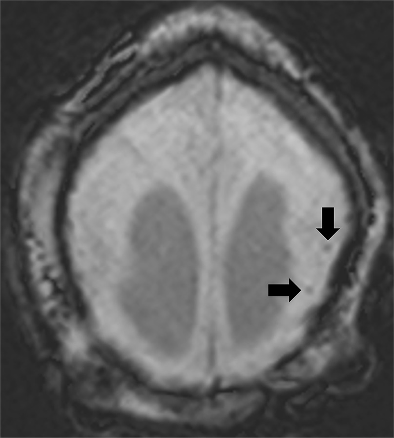 Axial susceptibility weighted imaging brain MRI demonstrating markedly diffuse simplified gyral pattern and scattered peripheral parenchymal calcifications.