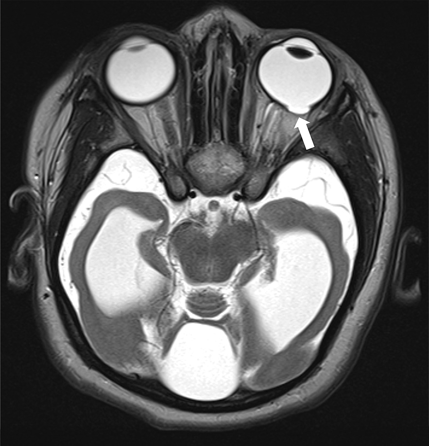 Axial T2 brain MRI demonstrating a chorioretinal coloboma (arrow) located in the posterolateral aspect of the left orbit as well as mild bilateral optic nerve atrophy (right optic nerve not shown).