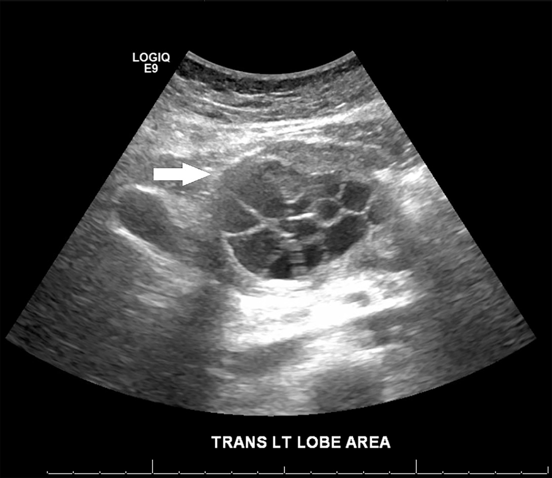 Transverse grayscale US image over the epigastrium. The arrow shows a thick-walled multiloculated cystic structure within the parenchyma of the left liver.