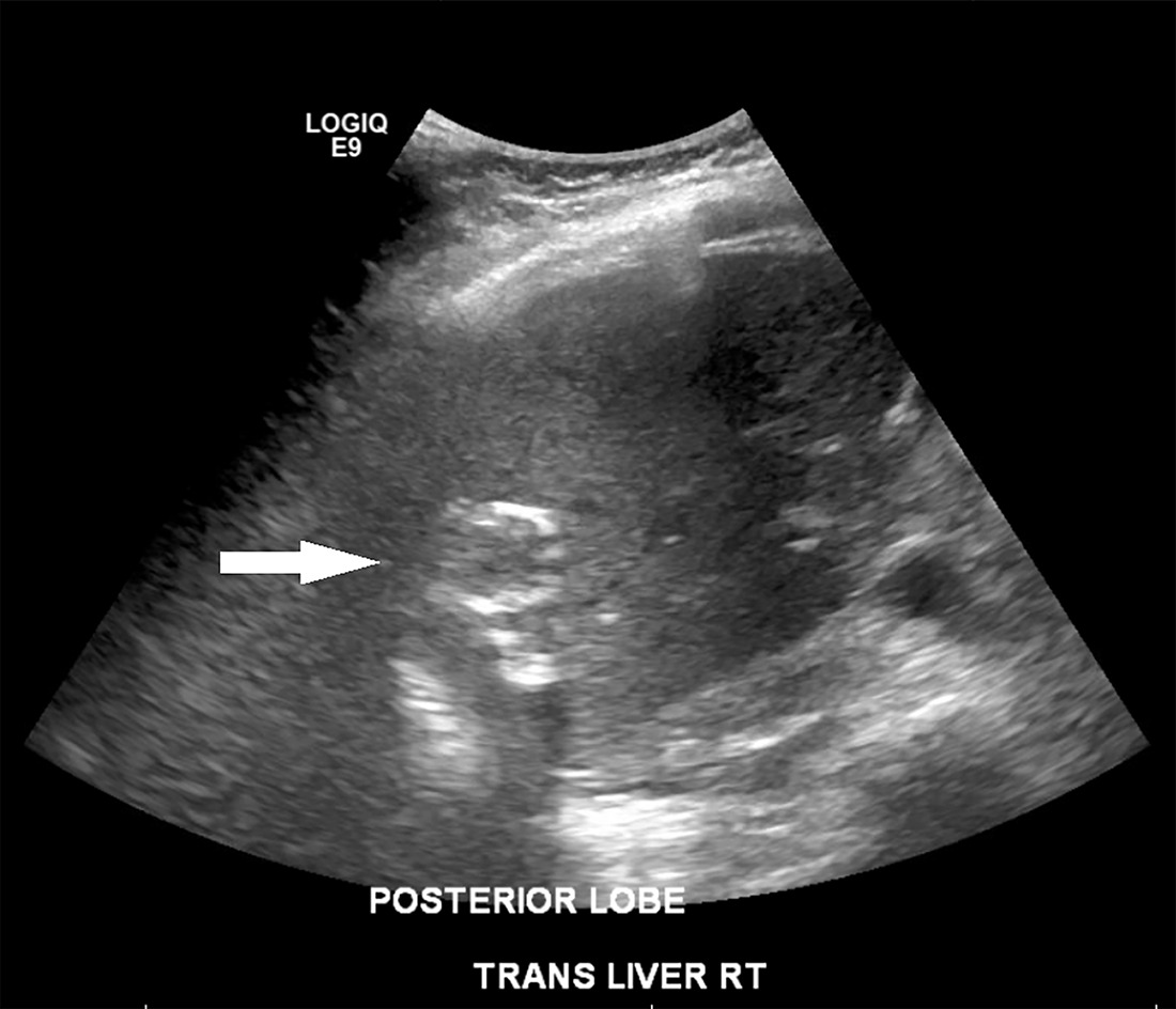Transverse grayscale US of the right upper abdomen. The arrow shows hyperechoic circular shadowing calcified lesions representing calcified cysts in the posterior right liver.