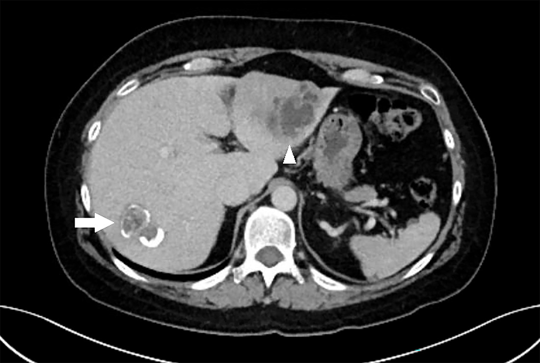 Axial contrast-enhanced CT of the abdomen. The arrowhead shows a heterogeneous complex cystic structure in segments 2 and 3 of the liver, representing an active echinococcal cyst containing smaller anterior daughter cysts. The arrow shows a well-marginated calcified cystic structure in segment 7 of the liver, representing chronic inactive disease.