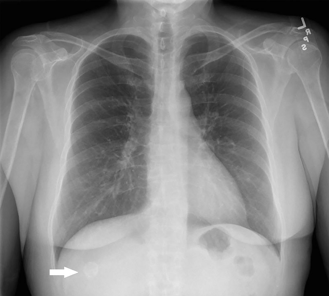 Frontal radiograph of the chest. The arrow shows a round, calcified lesion over the region of the right liver, corresponding to the calcified hydatid cyst seen on CT.