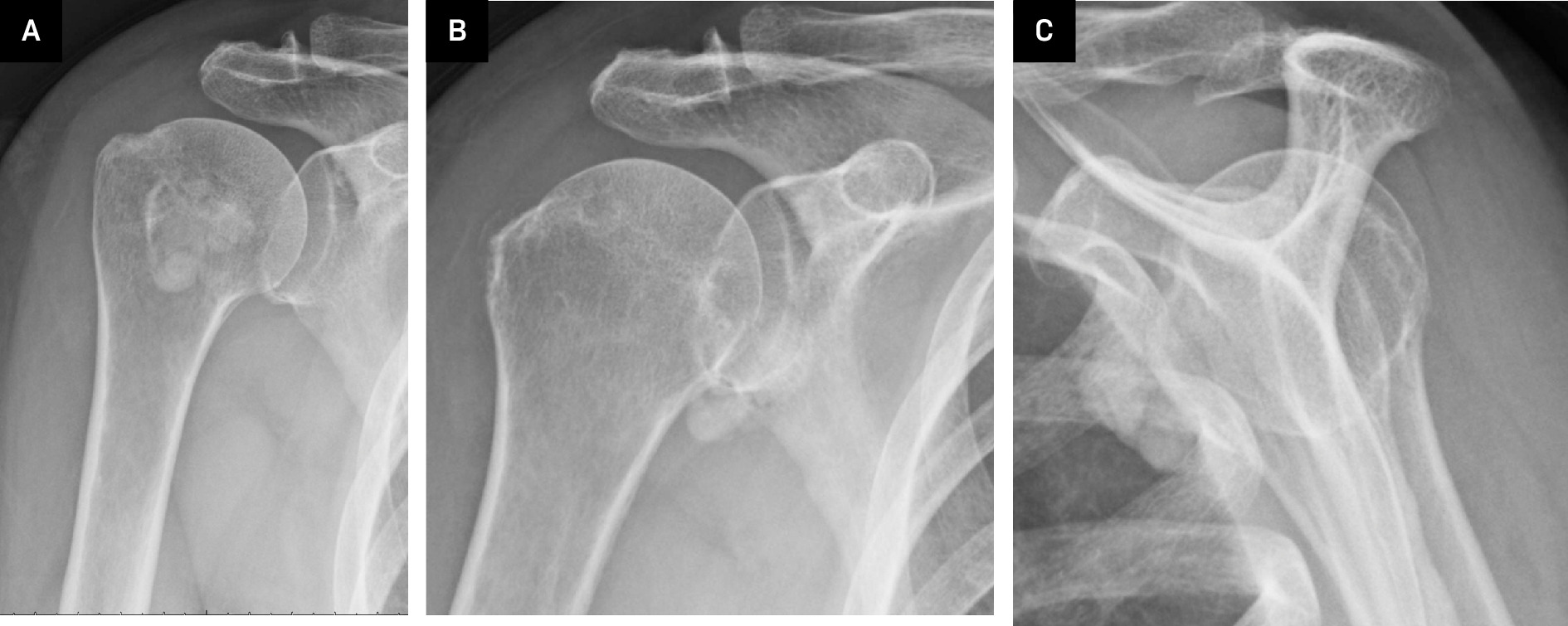 Radiographs of the right shoulder: Internal rotation (A), external rotation (B), and scapular Y-view (C) demonstrated multilobulated calcifications adjacent to the glenohumeral joint.