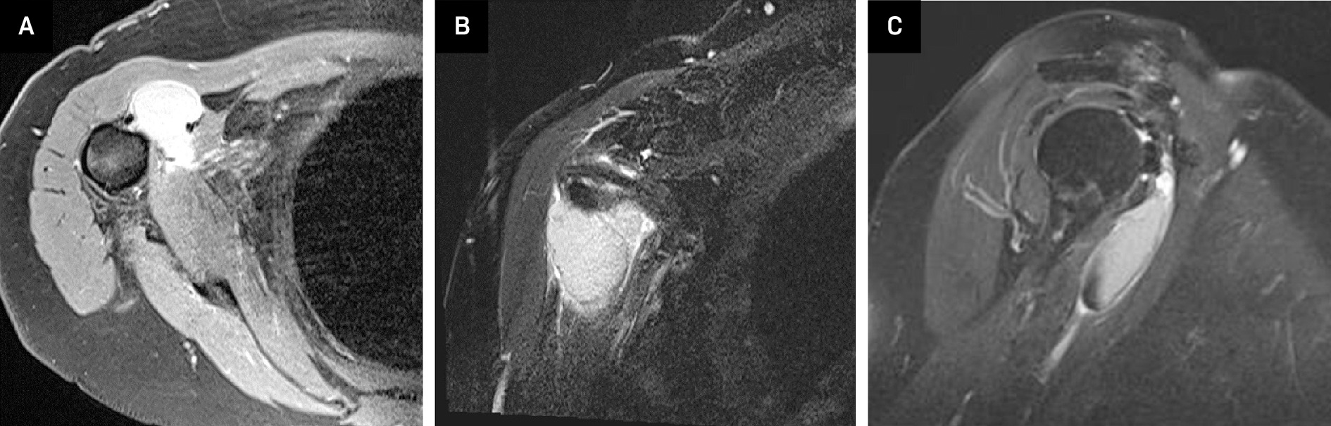 MRI shoulder without contrast: Axial view (A) of a proton density fast-spin echo sequence and a coronal view T2 fat-suppressed image (B) showed a 1.5 × 3.4 × 4.1 cm lesion which was hyperintense compared to skeletal muscle, but hypointense compared to fluid, located in a subcoracoid position. Sagittal view (C) showed a mild T2 hypointense signal along the inferior aspect of this lesion.