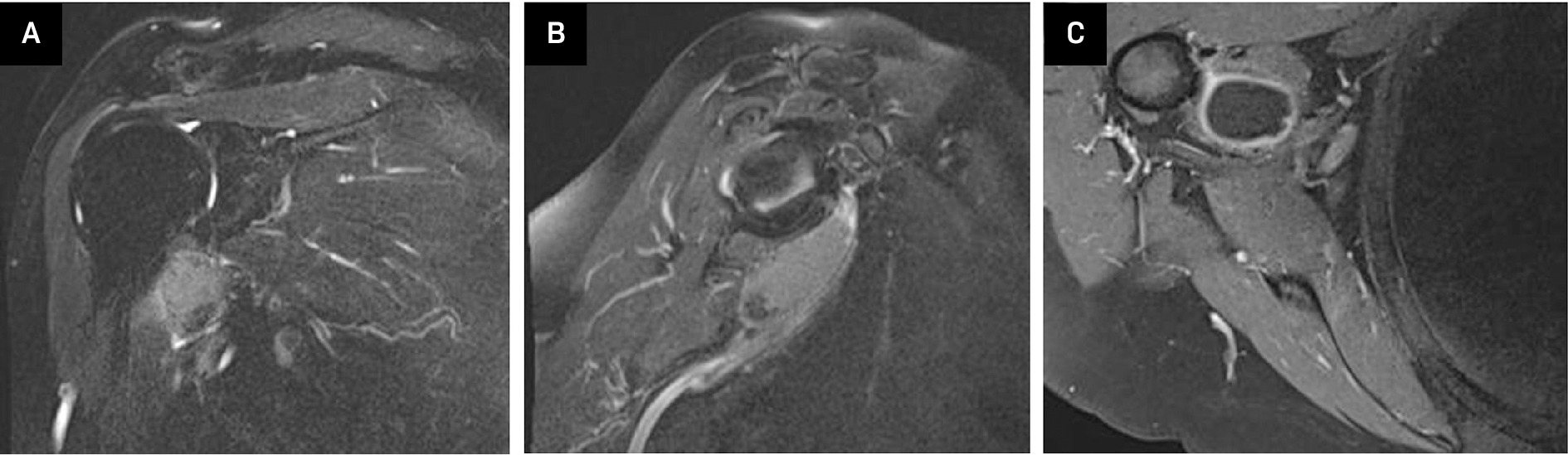 MRI with and without contrast: Coronal view (A) and sagittal (B) T2 fat-suppressed image without contrast again showed a hyperintense lesion within the subcoracoid bursa. A T1 axial fat-suppressed post-contrast image (C) showed peripheral enhancement around the synovial lining without internal enhancement.