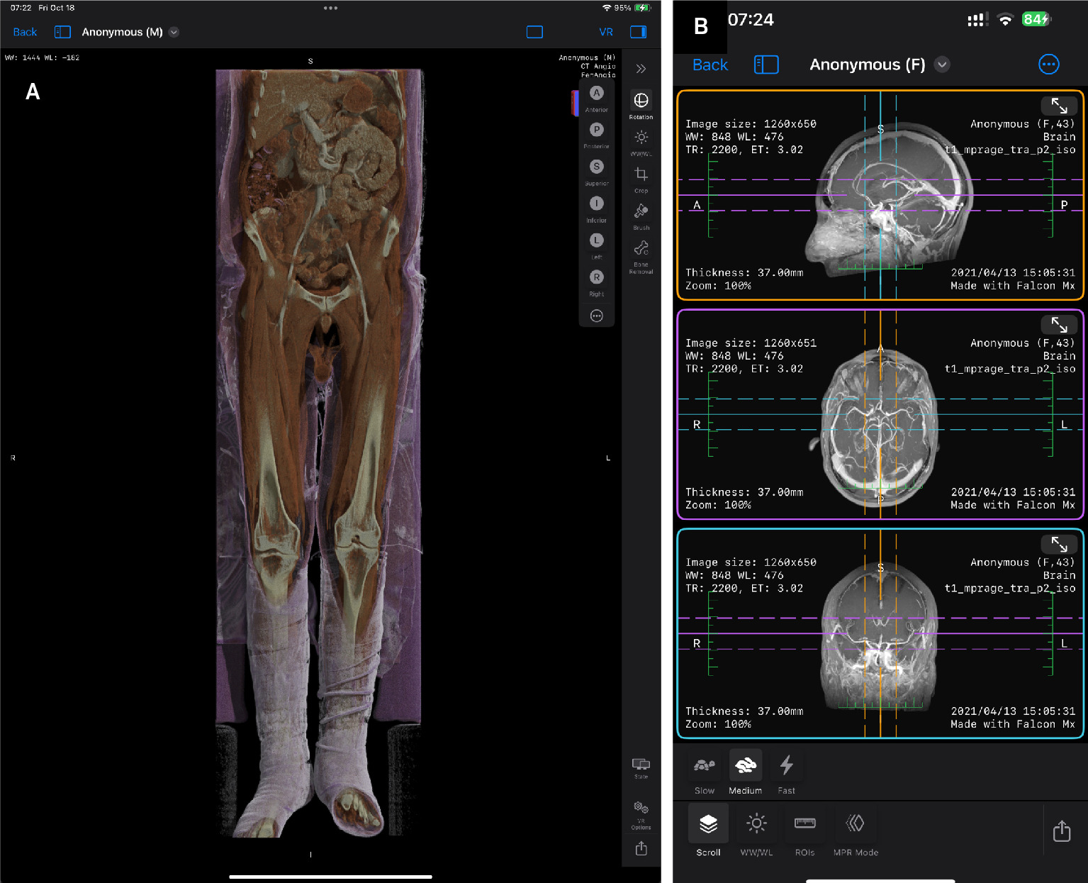 Falcon MD enables users to organize, view, and seamlessly share DICOM-format images on devices such as an iPad (A) and iPhone (B).