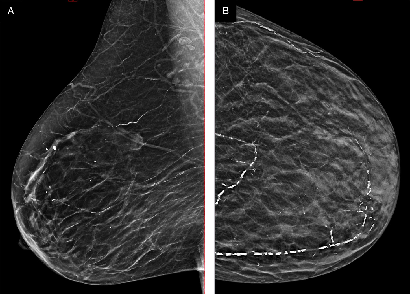 Right MLO (A) and left CC (B) views of a breast with Grade 3 breast arterial calcification. Images courtesy Canadian Society of Breast Imaging.