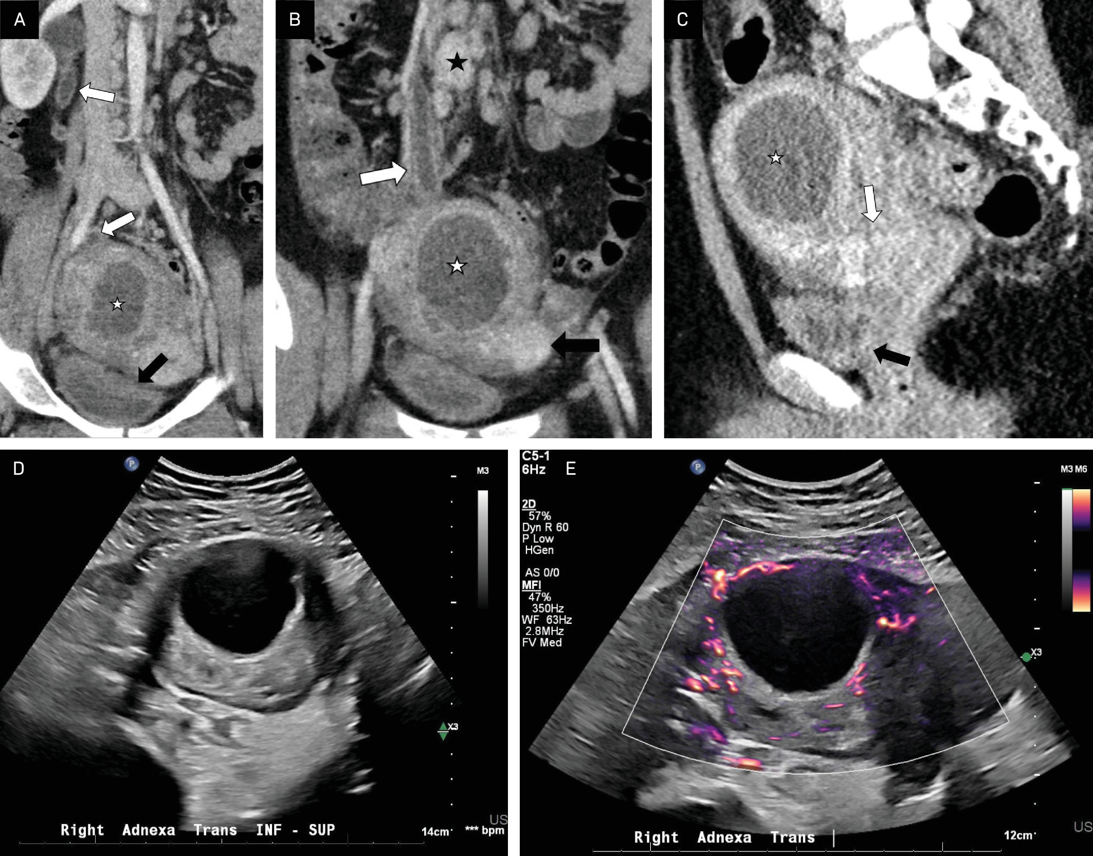 (A) Coronal CT pelvis with contrast demonstrating dilated, thickened ureter (white arrow) obstructed by tubo-ovarian abscess (white star). Note the relationship to the uterus (black star) and bladder (black arrow). (B) Coronal image demonstrating tubo-ovarian abscess (white star) and enlarged perivascular lymph nodes (black star). Also note hydroureter (white arrow) and uterus (black arrow). (C) Contrast-enhanced sagittal CT pelvis demonstrating the relationships of pelvic structures: tubo-ovarian abscess (white star), bladder (black arrow), and uterus (white arrow), which is poorly delineated owing to adjacent inflammatory changes. Ovaries were not distinctly visualized due to adjacent inflammation. (D) Pelvis US and (E) power Doppler US transverse views demonstrating 8.1 cm hypervascular right adnexa structure with cystic component.